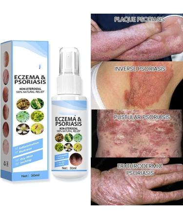 XWFJ Meellop Herbal Psoriasis Relief Spray - Soothes Eczema & Vitiligo, Repairs Skin - Face & Body - 1pc - Buy Online on GoSupps.com