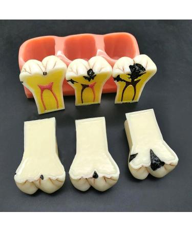 Buy Samnuerly 4-Fold Dental Teeth Caries Model - Removable Tooth Pathology & Evolutionary Display for Dental Training | International Shipping Available - Buy Online on GoSupps.com