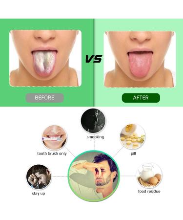 5-Piece Stainless Steel Tongue Cleaner Set | Fresh Breath & Bad Breath Relief for Adults & Children - Buy Online on GoSupps.com