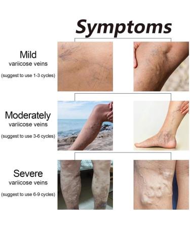 Japagzy Marrony Oil for Varicose Veins - Healing Spray Treatment (10ml 3 Box) | Effective Vein Care Solution - Buy Online on GoSupps.com
