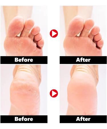 Urea Cream Urea 42% Foot Cream Ultra Moisturizing Heel Balm For Callus Removal and Soften Cracked Heel Repair Cream for Dry Skin Urea Lotion for Feet Hand & Body Maximum Strength - Buy Online on GoSupps.com