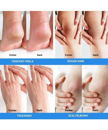 Cr me l'ur e avec 2 % d'acide salicylique pour les pieds - Pour talons secs et craquel s - Hydrate et limine les cors les callosit s les peaux mortes et adoucit les ongles des pieds - 140 ml - Buy Online on GoSupps.com