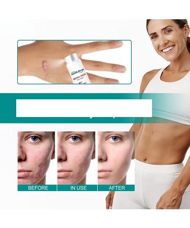 2pcs Advanced Scar Remove Spray & Cream Set (20g) - Physician Formulated Acne Scar Removal Gel | Moisturizing & Diminishing Results - Buy Online on GoSupps.com