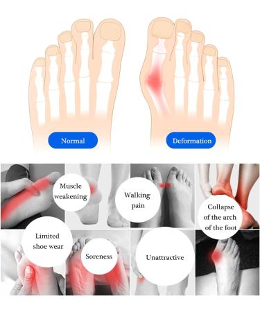 2 Pairs Honeycomb Gel Forefoot Pads - Soft Metatarsal Cushions for Men & Women | Relieve Foot Fatigue & Discomfort - Buy Online on GoSupps.com