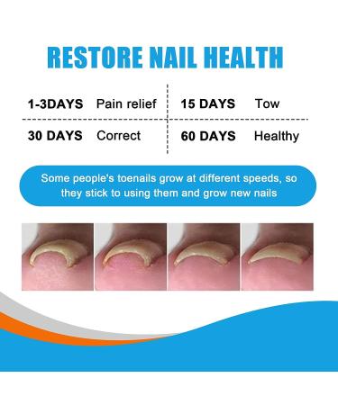Ingrown Toenail Removal Kit - Professional Pedicure Tool Set for Seniors, Includes Clippers, Corrector Patch, and Strips for Thick Toe Nails - Pain Relief Treatment - Buy Online on GoSupps.com