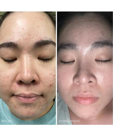 Glowbiotics Probiotic Triple Action Clarifying Pads - Breakout & Pigmentation Reducer with Glycolic Lactic & Salicylic Acid - 60 Pads for Brighter Clearer Skin - Buy Online on GoSupps.com