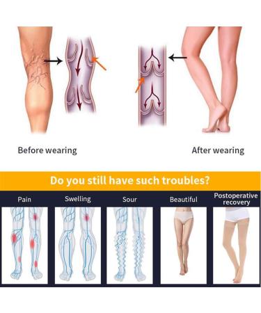 Keephen Medical High Compression Stockings for Varicose Veins & Edema - Grade II (23-32mmHg) Beige Open Toe - 2XL - International Shipping Available - Buy Online on GoSupps.com