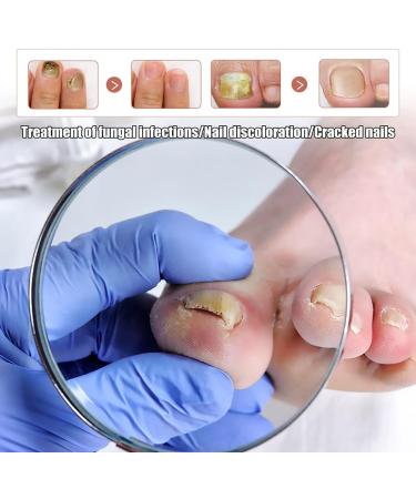 Nail Fungus Removal Liquid - Natural Toenail Fungus Oil for Effective Nail Care | BTSEURY - Buy Online on GoSupps.com