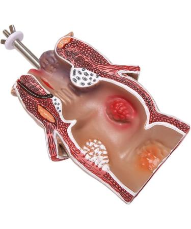 Hemorrhoid Lesion Model Human Rectal Pathological Anatomy Model Internal Model of Hemorrhoids External Model of Hemorrhoids Anal Model Tool Teaching - Buy Online on GoSupps.com