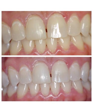 Ultra White 16% Teeth Whitening Gel - Large 5 Tube Pack - Buy Online on GoSupps.com