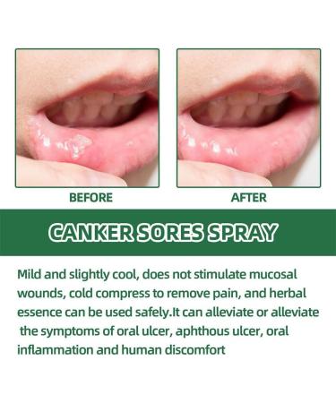 Antiviral Oral Ulcer & Canker Relief Spray 20ML - Herbal Breath Freshener - Buy Online on GoSupps.com