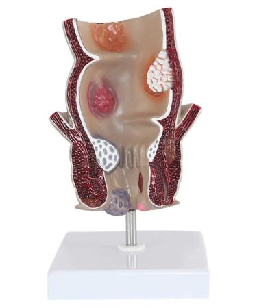 Medical Science Rectum Fissure Lesion Model 5X Human Pathology Model Hemorrhoid Anal Fistula Medical Organ Model