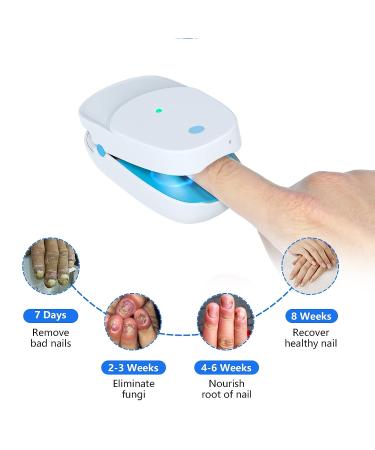 Effective Toenail Fungus Laser Remover Device for Onychomycosis Treatment - Nail & Toe Fungal Cleaning Solution - Buy Online on GoSupps.com