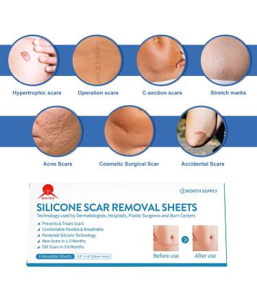 MT Healthy Silicone Scar Removal Sheets - 6 Pcs (5.9 x 1.6 inches) - 3 Months Supply - Reusable & Washable - Comfortable & Painless - For Hypertrophic Scars and Keloids - Buy Online on GoSupps.com