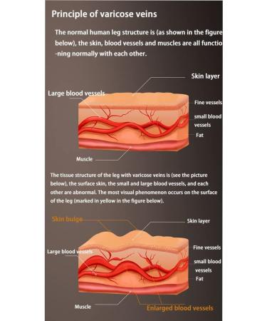 Large Long Nine-Quarter Varicose Vein Therapeutic Socks - Leg Protection Anti-Thrombotic Medical Support | Black, Size Large - Buy Online on GoSupps.com