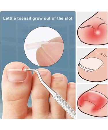 Toenail Corrector Patch Ingrown Nail Corrector Ingrown Nail Treatment Ingrown Nail Corrector Stickers Toenail Correction Toenail Patch - Buy Online on GoSupps.com