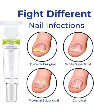 DUBUSH Anti Paronychia Relief Cream Nail Repair Solution Nail Treatment Repair Gel Nail Repair for damaged gel Toe Instant Beauty Gel for damaged discolored thick nails - Buy Online on GoSupps.com