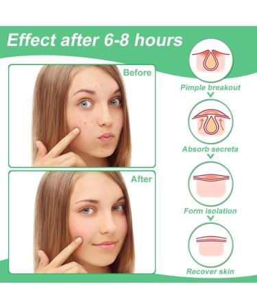 Zebran 300 Pcs Hydrocolloid Pimple Patches - Invisible 2-in-1 Acne Treatment Waterproof Day & Night Solution - Buy Online on GoSupps.com