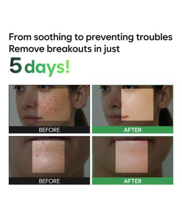 Saekdong Seoul Hypochlorous Acid Tea Tree Cica Bubble Serum Advanced Bubble Trouble Care for Sensitive & Acne-Prone Skin Oil Control & Skin Barrier Support 1.01 fl oz 30ml - Buy Online on GoSupps.com