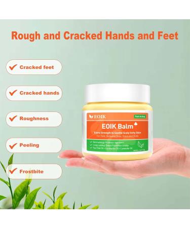 Heat Rash Cream  Eczema  Hand Foot Treat  Tinea Versicolor  Itchy Feet  Butt  Anal Itch  Psoriasis  Scalp Dandruff  Bee Sting  Bites  Boil Cyst  Armpit  Adults Kids  Hidradenitis Suppurativa Treat - Buy Online on GoSupps.com