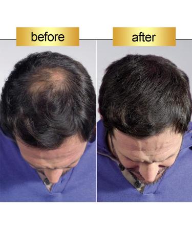 Hair Fiber for Thinning Hair & Bald Spots - Natural Hair Building Fibers Instantly Thicker Hair (Medium Brown) - 25g | Ideal for Men & Women - Buy Online on GoSupps.com