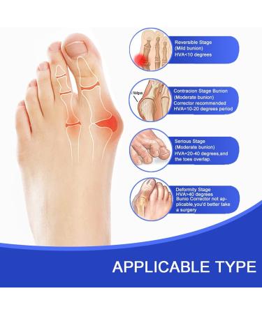 2022 Updated Toe Separator Bunion Corrector Set - Bunion Splint & Hallux Valgus Brace Kit for Bunion Pain Relief - Orthopedic Toe Alignment Tool with Free Blue Exercise Strap - Buy Online on GoSupps.com