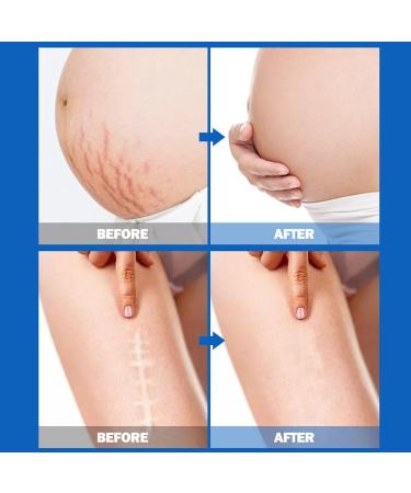 90pcs Pregnancy Stretch Marks Essential Oil | Skin Care & Beauty - Abdominal Massage Oil for Effective Stretch Mark Removal - Buy Online on GoSupps.com