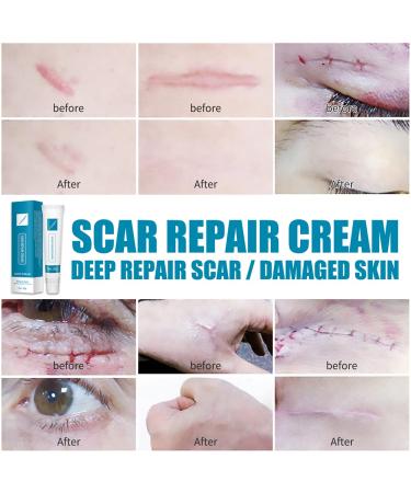 Acne Scar Treatment Gel - Scar Remover for Face & Body - 20g - Buy Online on GoSupps.com