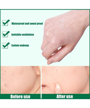 Hydrocolloid Acne Pimple Patch | Invisible Blackhead & Blemish Remover - Buy Online on GoSupps.com