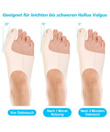 Soarfly Hallux Valgus Correction | Adjustable Bandage & Non-Slip Heel Strap for Pain Relief Day & Night Support for Foot Problems - Buy Online on GoSupps.com
