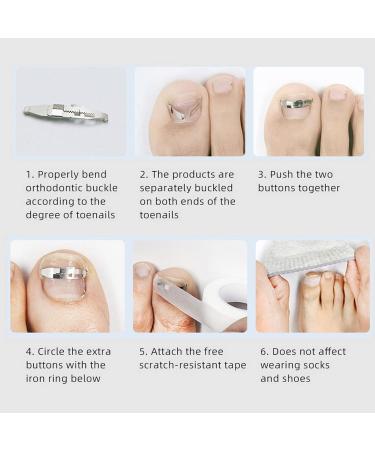 2PCS Ingrown Toenail Corrector Stainless Steel Paronychia Correction Tool with 2 Replacement Corrector for Effective Pain Relief for Toenail Correction - Buy Online on GoSupps.com