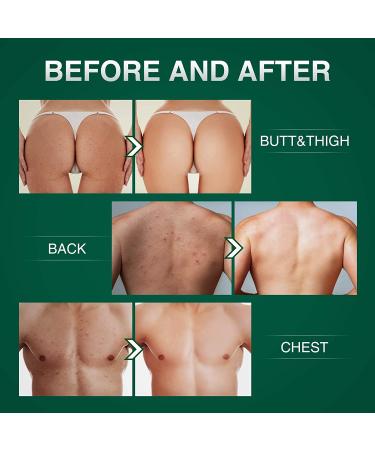 Acne Treatment Cream for Butt & Thigh - Removes Pimples, Ingrown Hairs - Spot & Cystic Acne Treatment - Moisturizes and Repairs Skin - Buy Online on GoSupps.com