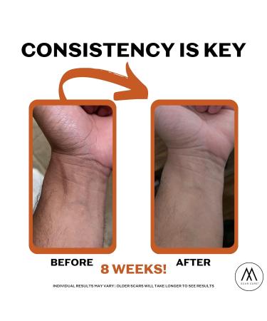 Motivo Scar Care Bundle - Scar Tape & Cream (15ml) | Water & Sweat Resistant, Ideal for Surgical, C-Section, Trauma & Acne Scars | Suitable for All Skin Types | Tan - Buy Online on GoSupps.com