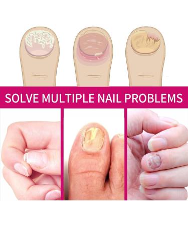 Strengthener for Damaged Nails Versatile Repair Care 10ml Cuticle Repair Oil - Yellow Foot and Nail Care - Ingrown Toenail Prevention - Men and Women - Buy Online on GoSupps.com