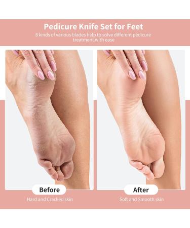PARTURI 5-Pack Rose Gold Pedicure Knife Kit - Professional Foot Dead Callus Remover and Ingrown Toenail Tool Set for Skin Care and Manicure - Stainless Steel Nail File, Clippers, Cuticle Scraper, Toe Shaver - Buy Online on GoSupps.com