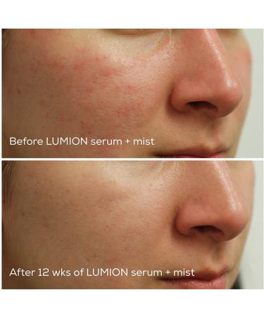 LUMION Skin Miracle Mist with Oxygen & Hypochlorous Acid | Natural, Healthy, Calm & Clear Skin | 3.4 fl oz (100 ml) - Buy Online on GoSupps.com