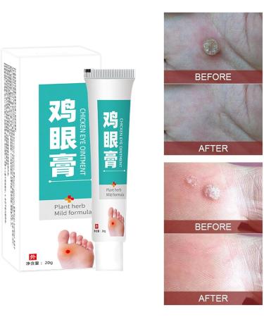 JIEJIEHOUSE Anticallus cream anticorn skin ointment corn remover callus remover foot gel against calluses and corns for women and men 20 g - Buy Online on GoSupps.com