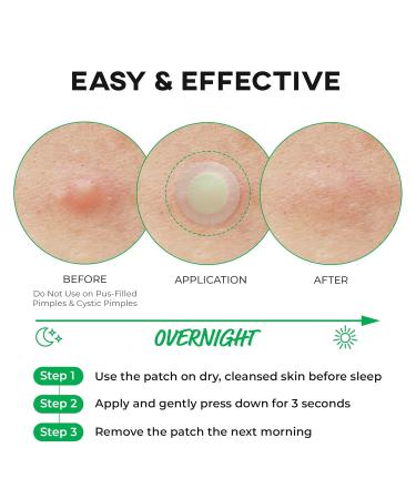 Spot Eraser Green Micropoint Pimple & Dark Spot Patches | Effective Zit Stickers for Face | 9 Patches for Early-Stage Spots - Buy Online on GoSupps.com