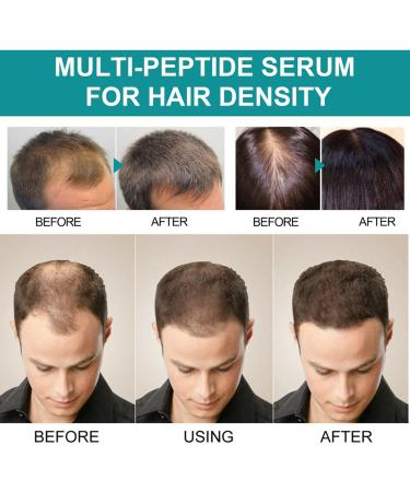 The Ordinary Multi-Peptide Hair Density Serum 60ml | Vegan Hair Growth Serum for Men & Women | Best for Volume & Density | Order 1-3 Pieces Online - Buy Online on GoSupps.com