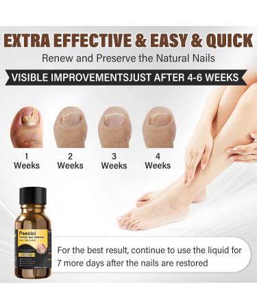 Extra Strength Toenail Treatment - Nail Treatment for Fungus & Discoloration (1 fl oz/30 ml) | Effective Toe Nail Solutions - Buy Online on GoSupps.com