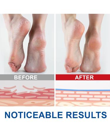  G n rique Urea Cream 60% Moisturizing Repair Foot Cream Deeply Hydrates and Softens Cracked Heels Cream for Very Dry and Damaged Feet 40g (2) - Buy Online on GoSupps.com