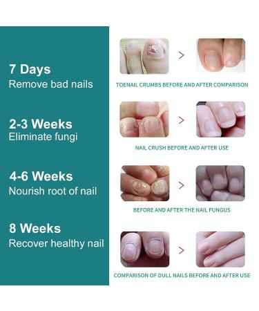 Touchscreen Nail Fungus Laser Treatment Device - Targets Damaged Toenails - Onychomycosis Treatment - Buy Online on GoSupps.com