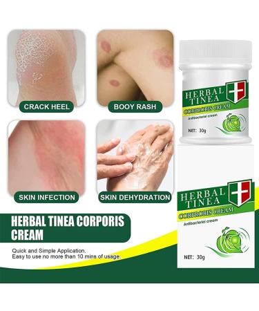 Anshka Herbal Tinea Corporis Cream - Gentle Relief for Tinea Skin Itching (3pcs) - Buy Online on GoSupps.com