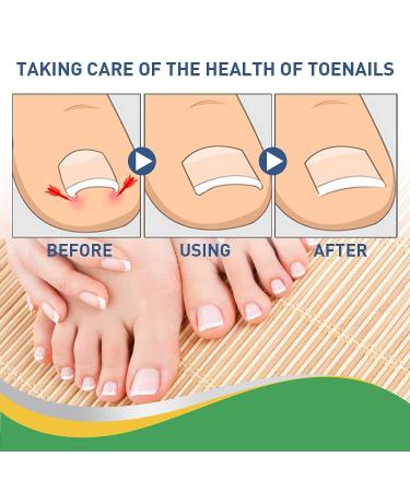 Fitmedify Nail Patches - Toenail Correction Tool for Ingrown Nails, Fungus Relief (50Pcs) - Buy Online on GoSupps.com