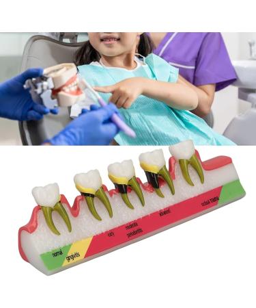 Realistic Dental Periodontitis Model - Study Dental Teeth in Various Stages | Synthetic Resin Educational Tool - Buy Online on GoSupps.com