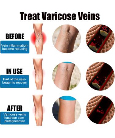 Xirujnfd Vein Healing Spray - Effective Varicose Veins Treatment for Legs | Improve Blood Circulation (1PCS) - Buy Online on GoSupps.com