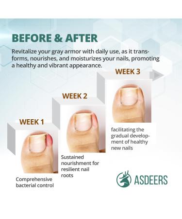 Ingrown Toenail Treatment - Easy Home Removal Kit for Men & Women | Nail Reliever & Softener Tools - Buy Online on GoSupps.com