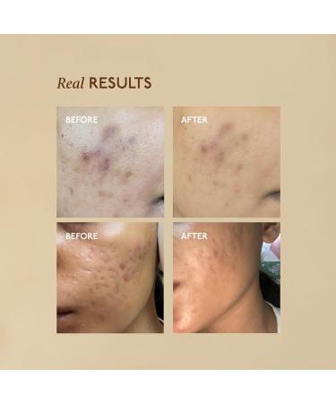 ASAYA Pigmentation Serum Reduces Dark Spots Acne Marks Melame Complex Niacinamide & Alpha Arbutin Evens Skin Tone & Brightens Lightweight & Fast Absorbing For Unisex 30 ml (Pack of 1) Blue - Buy Online on GoSupps.com