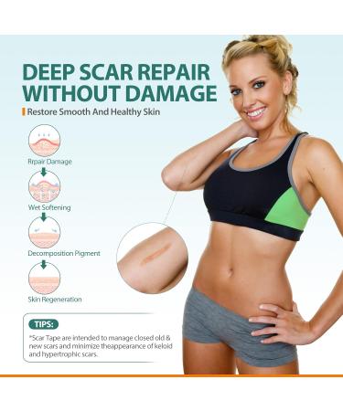 Geloo Silicone Scar Sheets (Roll-4M) | Reusable Scar Treatment Strips for C-Section Keloid Surgery Acne & Burns - International Shipping - Buy Online on GoSupps.com