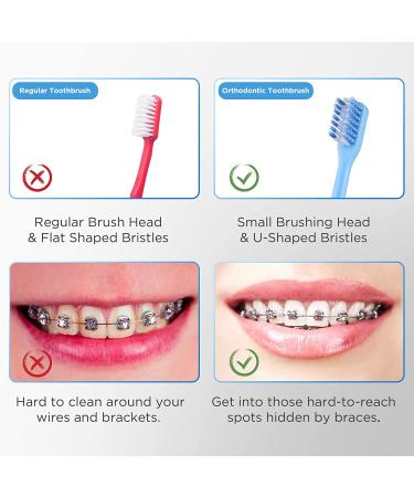 Fremouth V-Shaped Orthodontic Toothbrush for Braces - Soft Bristles - 6 Count (Upgraded) - Buy Online on GoSupps.com